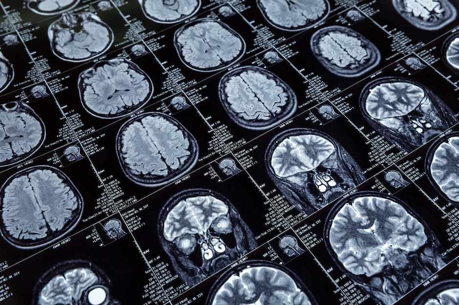 Senior Solutions Management Group Answers the Question: What is Alzheimer's Disease?